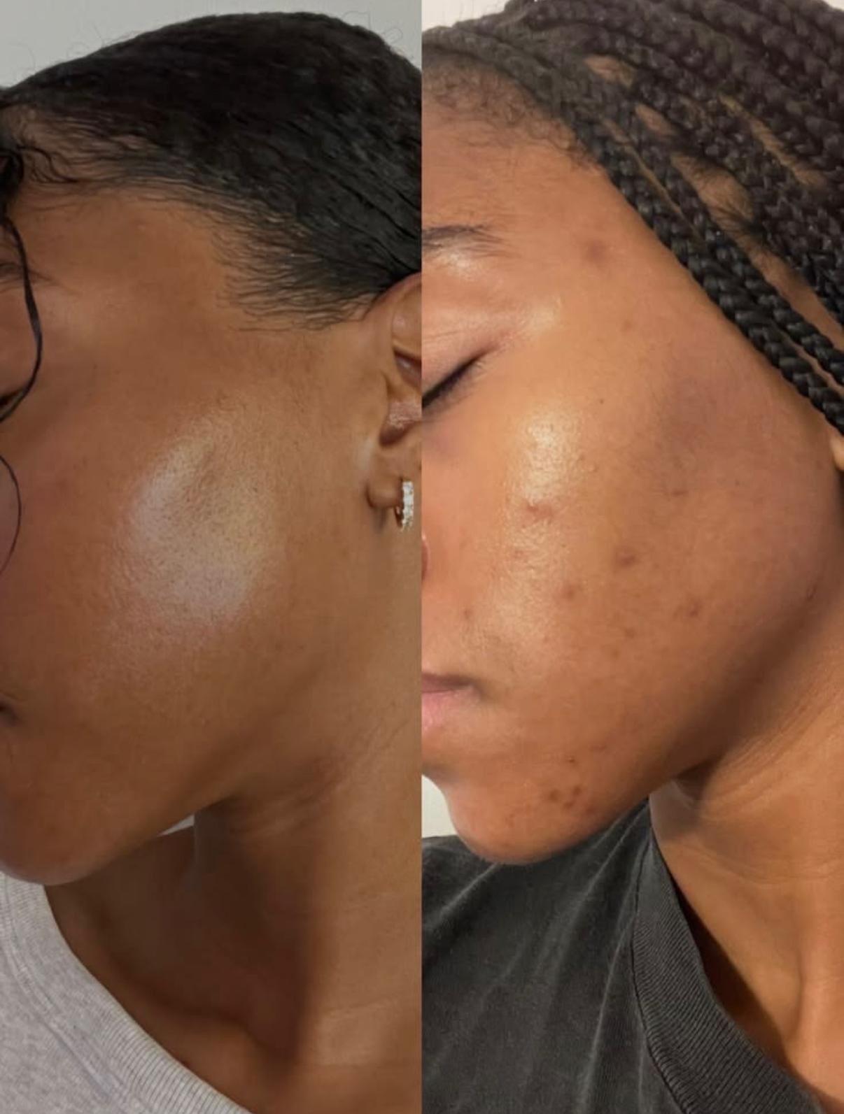 Avant/après microneedling à Repentigny : texture de peau affinée et imperfections atténuées