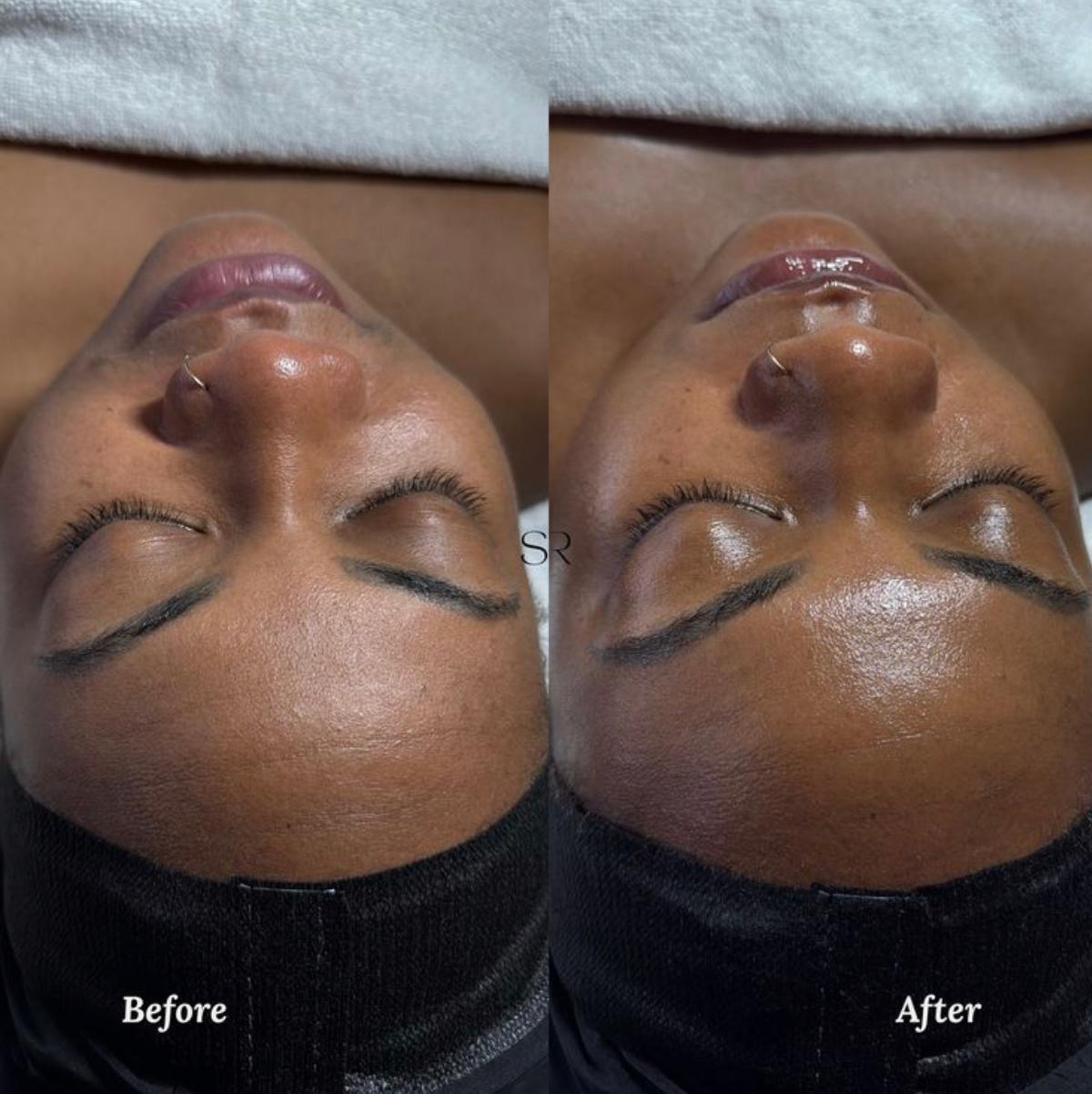 Avant/après Hydrafacial à Repentigny : points noirs extraits et pores du nez resserrés