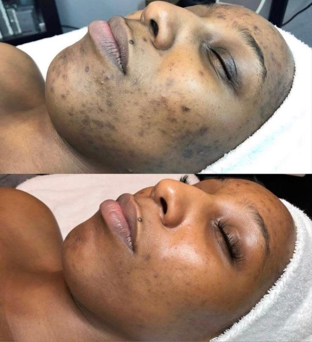 Avant/après peeling chimique à Repentigny : teint unifié et éclat du visage